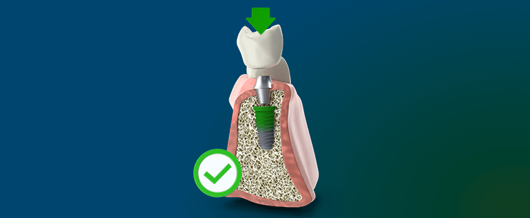 biomecânica nos implantes dentários