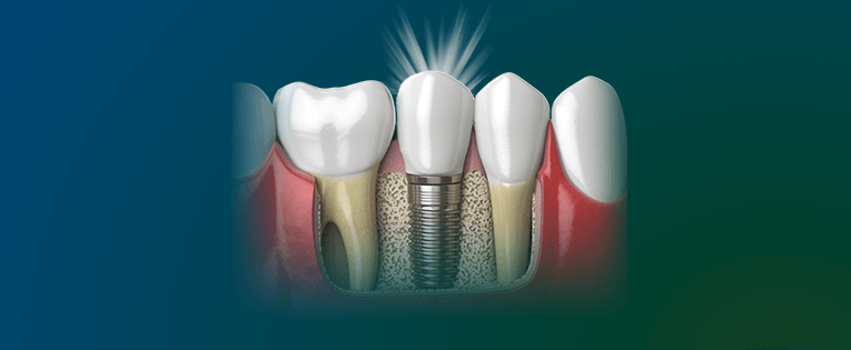 implantes curtos e estreitos