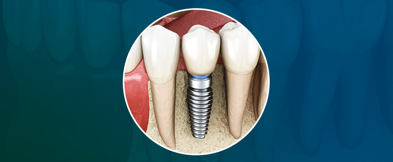 carga imediata vs carga tardia