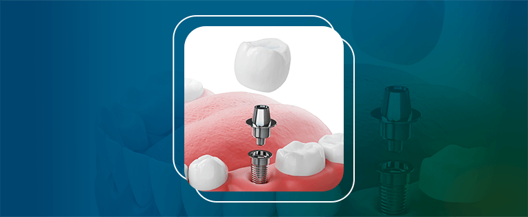 implantes dentários técnica flapless